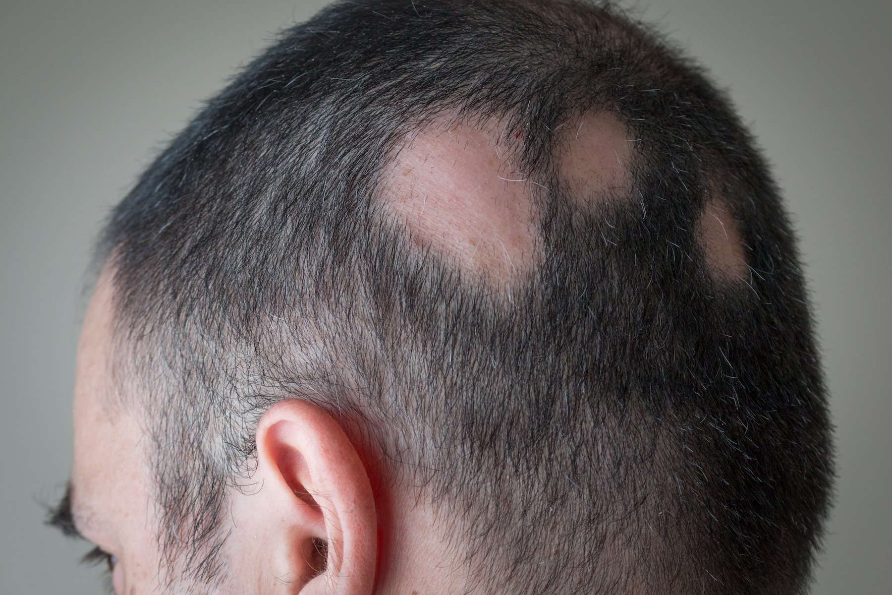 Alopecia Types Causes Symptoms and Treatment