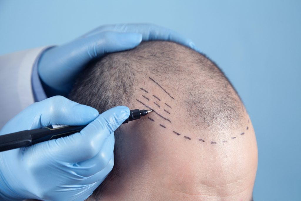 How to Choose a Hair Transplant Doctor