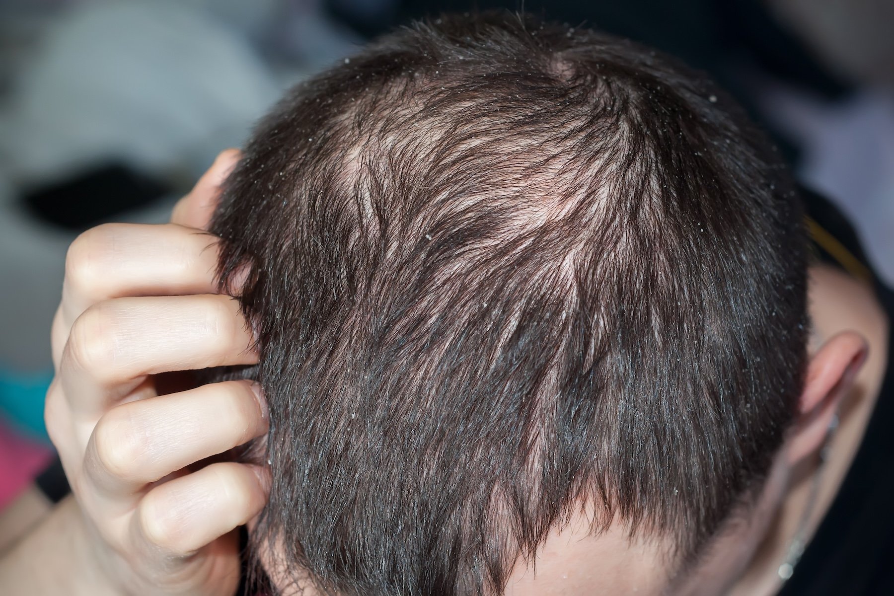 Best Alopecia Areata Treatment in Jabalpur | Dr Meets Clinic