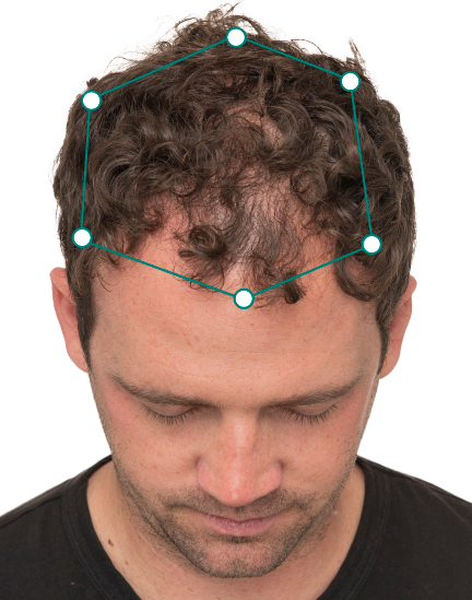 Nutrafol-Brain-before